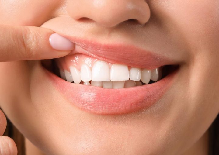 Cómo se trata la Amelogénesis imperfecta en Dental Millán, tu dentista en Cuenca te lo contamos